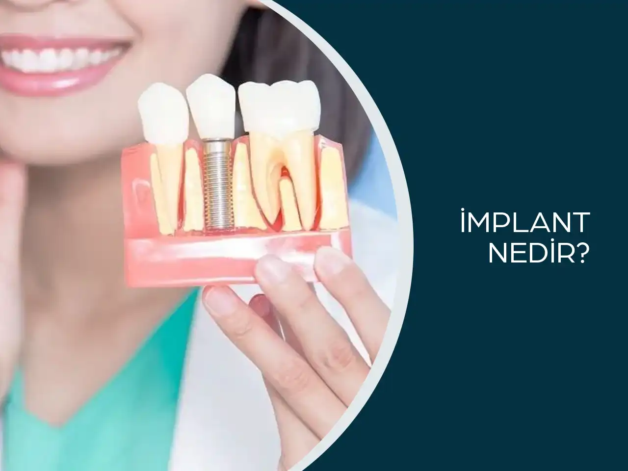İmplant Nedir?